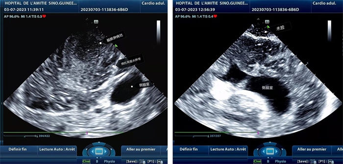 左圖顯示術(shù)中超聲見囊實(shí)性病變，大小約為4x4x3cm，病灶周圍腦組織水腫明顯；右圖為病灶切除后，術(shù)中超聲示術(shù)腔無病變殘留