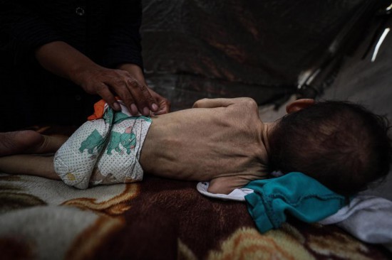 這是5月28日在加沙城西部一處臨時(shí)安置點(diǎn)拍攝的一名營(yíng)養(yǎng)不良的嬰兒。新華社發(fā)（馬哈茂德·扎基攝）